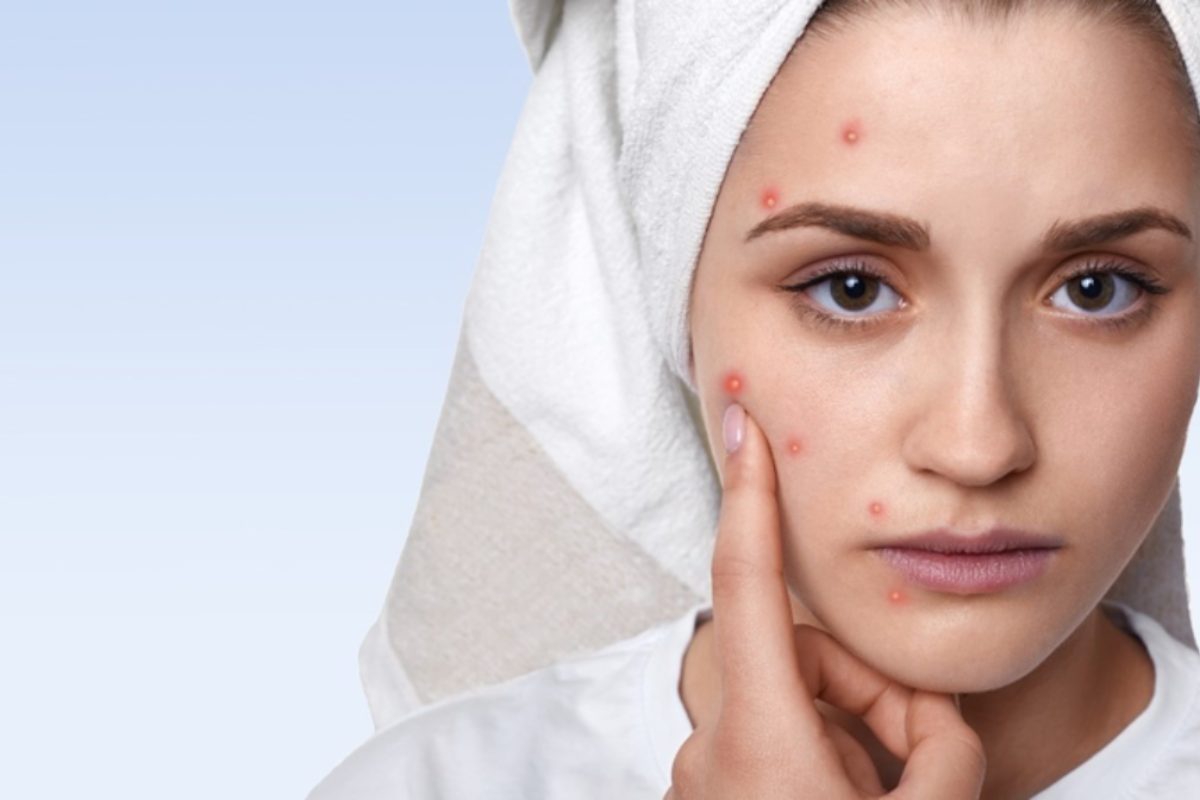Nguyên nhân gây mụn trước đám cưới bao gồm stress và ăn uống không điều độ. (Ảnh: Sưu tầm) 