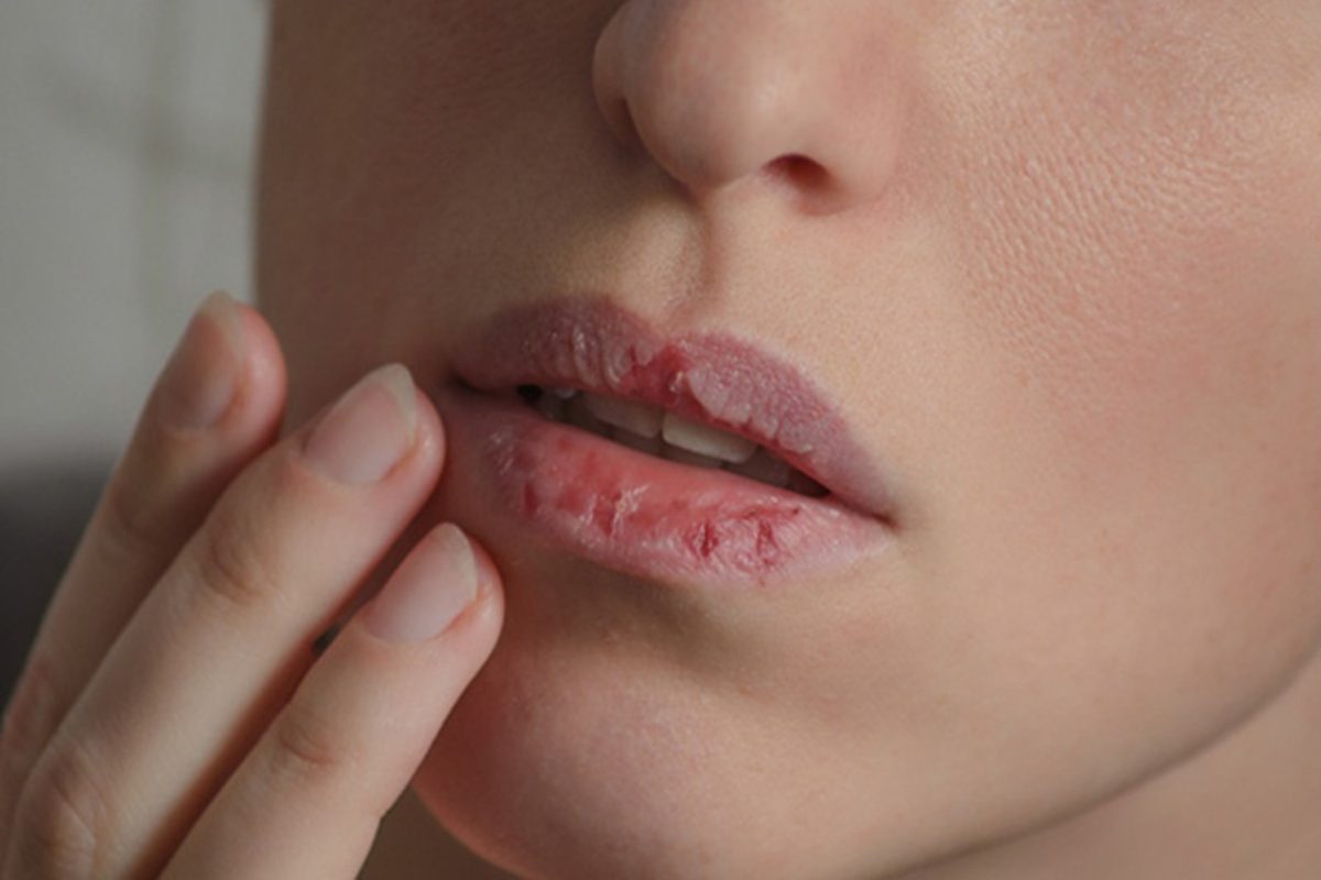 Nguyên nhân khiến đôi môi bị khô và nứt nẻ (Ảnh: sưu tầm)