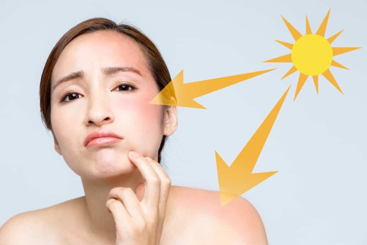 Da bị cháy nắng trước ngày cưới cần phải làm gì? (Ảnh: sưu tầm)