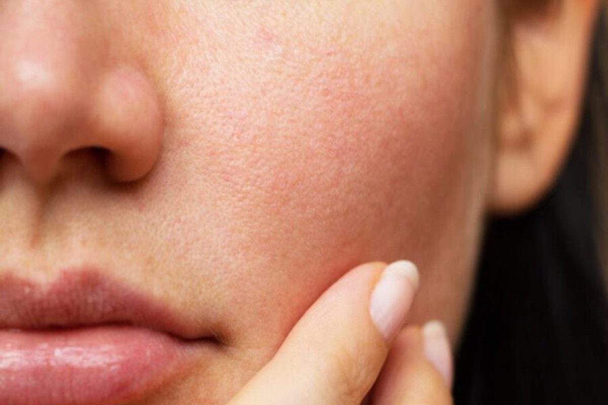 Các biện pháp giải cứu da bị cháy nắng (Ảnh: sưu tầm)